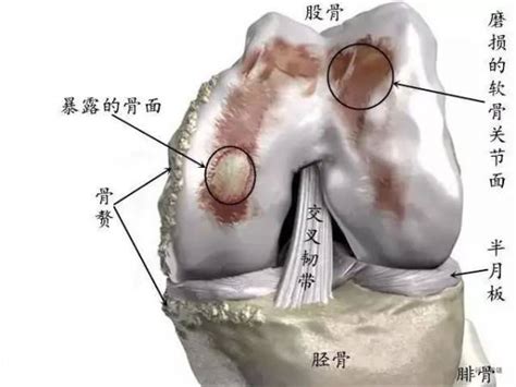 治疗膝关节炎最佳最快的方法效果哪家专业？有好的民间偏方吗？症状磨损关节炎