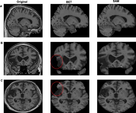 Brain Extraction Comparing Segment Anything Model Sam And Fsl Brain