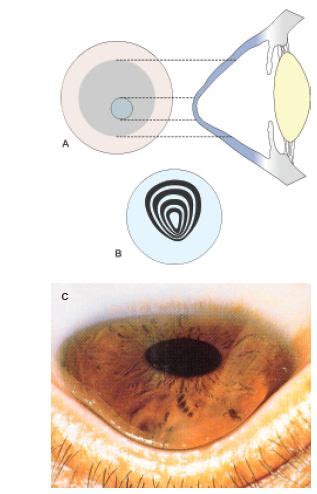 Ophthalmology | Ophthalmologist: KERATOCONUS , KERATOGLOBUS ...