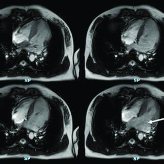 Severe Mitral Regurgitation On Cardiac Magnetic Resonance Imaging