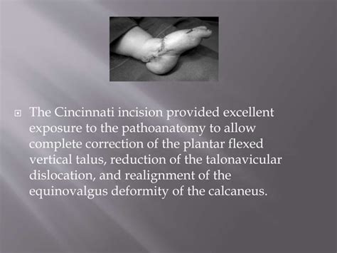 Congenital vertical talus