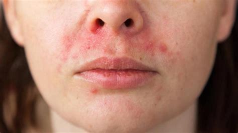 Nadar Estoy Feliz Propuesta Dermatitis Perioral Pomada Calina Cortés