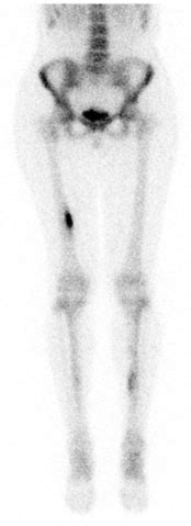 Femoral Stress Fracture - Physiopedia