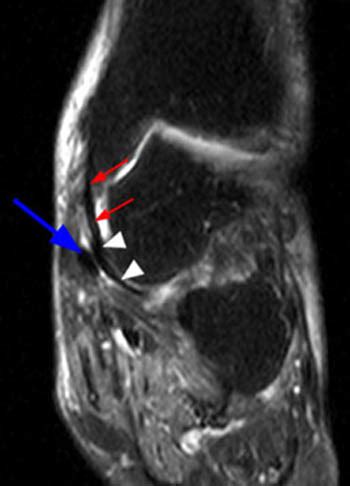 MRI Musculo-Skeletal Section: Spring complex ligament.