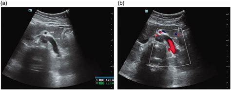 Nutcracker Syndrome Accompanied By Hypertension A Case Report And Literature Review Rui Feng