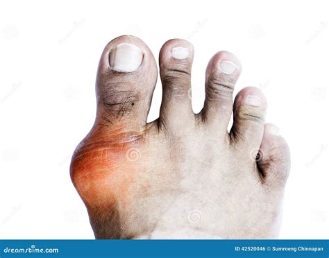 196 Gout Big Toe Photos - Free & Royalty-Free Stock Photos from Dreamstime