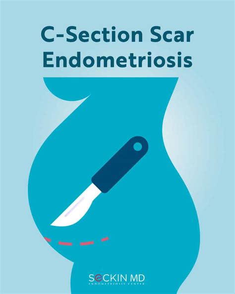 C Section Scar Endometriosis Seckin Endometriosis Center