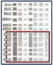 Instructors' Collection ECG: Hyperacute T Waves: de Winter T Waves ...