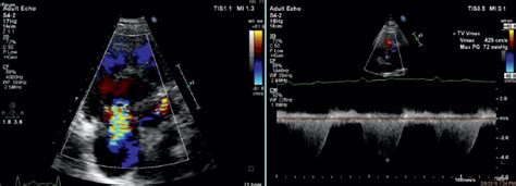 Transthoracic Echocardiography Apical View Color Doppler Continuous