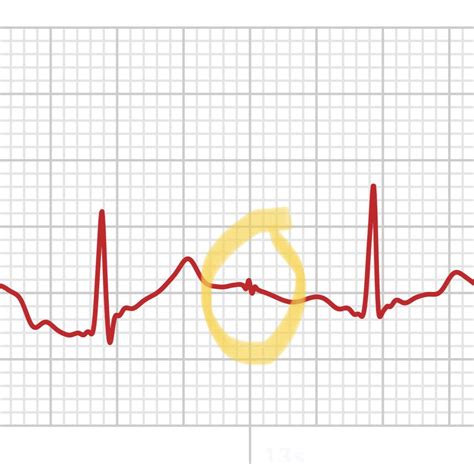 Is this normal on an EKG? : r/askCardiology