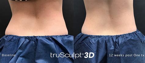 Trusculpt D Before And After Photo Columbia Skin Clinic