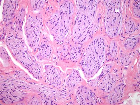 Traumatic Neuroma Dermatopathology