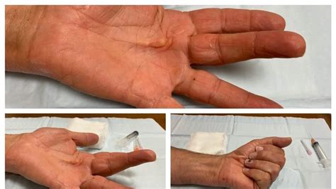 Comparing Treatments For Dupuytren Contracture A Closer Look At