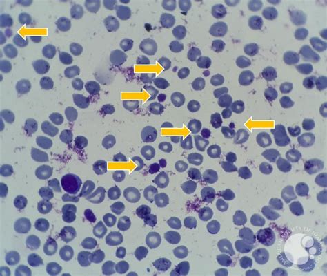 presentation of many large platelets in peripheral blood 4