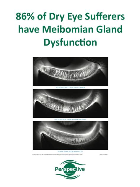 Dry Eye Doctor Vancouver Dr M K Randhawa Optometrist Offering Lipiflow Punctal Plugs