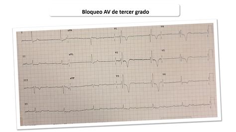 BAV 3º grado Cardioprimaria Ferrol