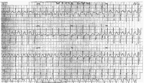 Ecg Case 106 Left Atrial And Left Ventricular Hypertrophy Lvh