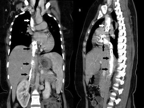 Calcification In The Veins