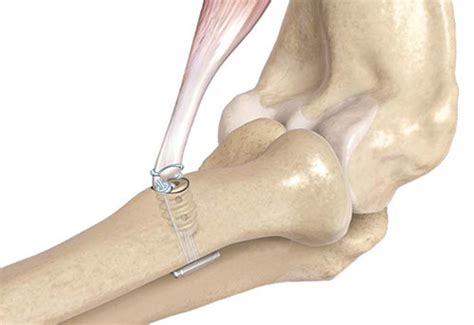 Distal Biceps Rupture and Tendon Reconstruction - Perth Orthopaedic Specialist Centre