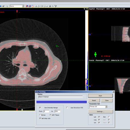 The Illustration Of Conebeam Computerized Tomography Registration For