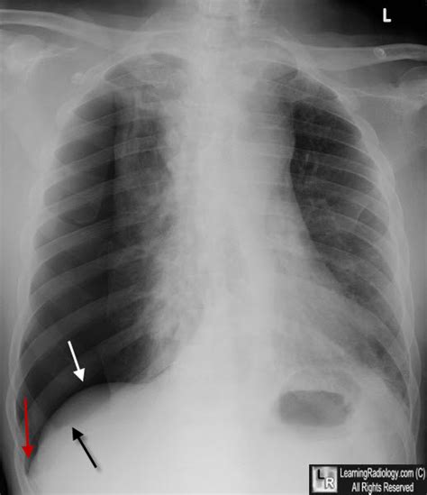 Learning Radiology Deep Sulcus Sign Pneumothorax