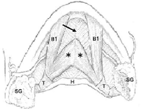 Figure From The Digastric Muscle S Anterior Accessory Belly Case