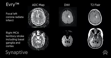 Synaptives First Inpatient Scans With Evry™ Synaptive Medical