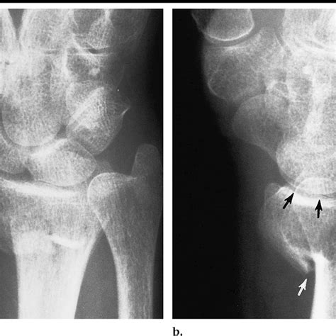 Volar Barton Fracture Distal Radius Fractures