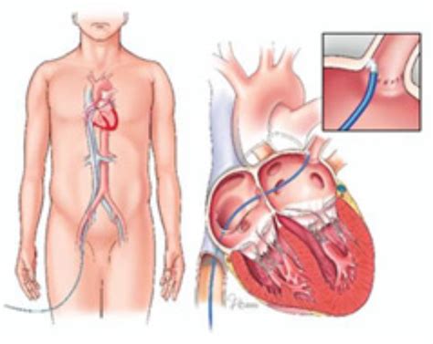 Atrial Fibrillation Ablation Mayo Clinic