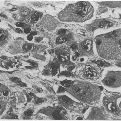 Oat Cell Carcinoma Within Alveolar Space Many Positively Stained Download Scientific Diagram