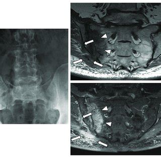 Radiograph And MRI Of The SIJ Of A 40 Yo Male Patient With Low Back