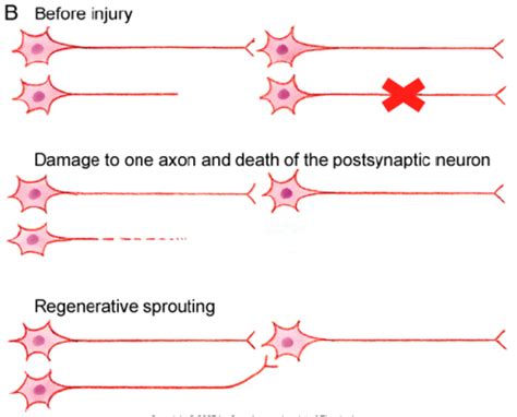 Module 13 Neural Regeneration after Peripheral Nerve Injury Flashcards ...