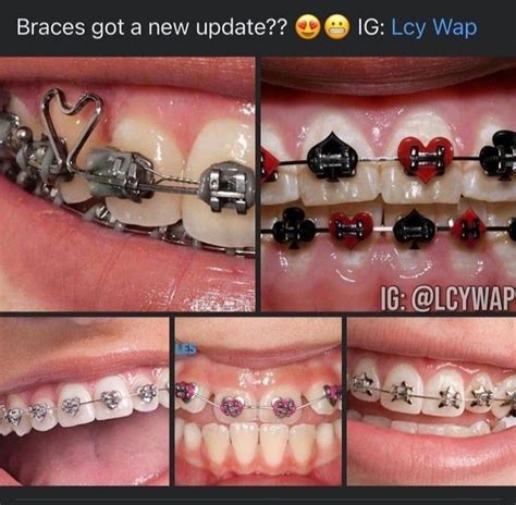 Red Braces Dental Braces After Braces Cute Braces Colors Getting