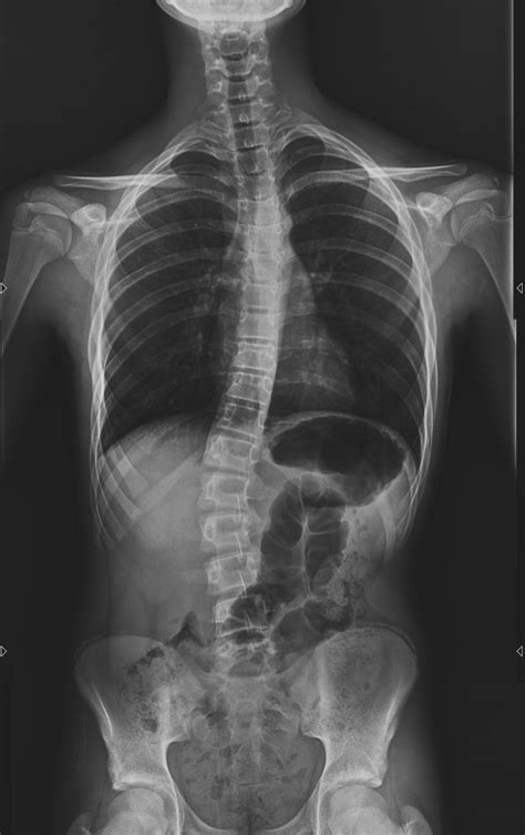 La Escoliosis Una Columna Vertebral Un Tanto Diferente Denufi