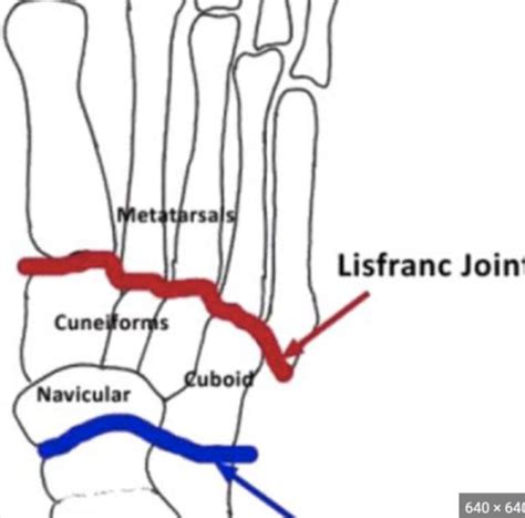 PTA 111 Partial Foot Amputations Flashcards Quizlet