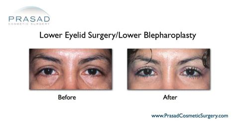 Transconjunctival Blepharoplasty Eyelid Surgery New York City