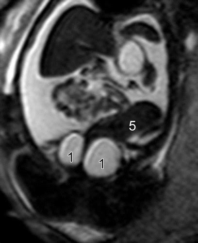 Airp Best Cases In Radiologic Pathologic Correlation Prenatal And Postmortem Imaging Of A