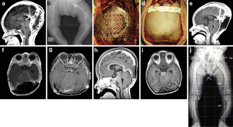 Case 1 A Gadolinium Enhanced T1 Weighted Mri Showed An Extra Dural