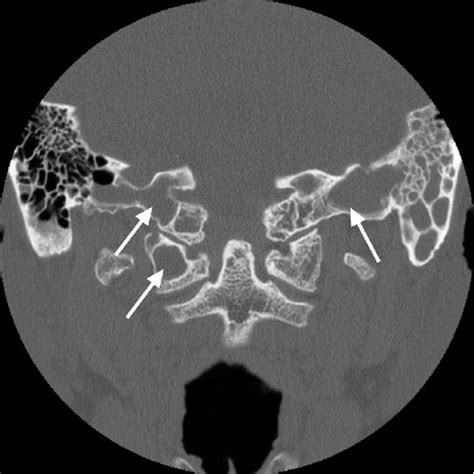 Orbital Varix A Year Old Woman Who Presented Due To An Orbital Mass