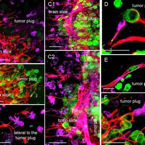 Cxcr Expression In Astrocytes And Microglia In Human Brain Metastasis