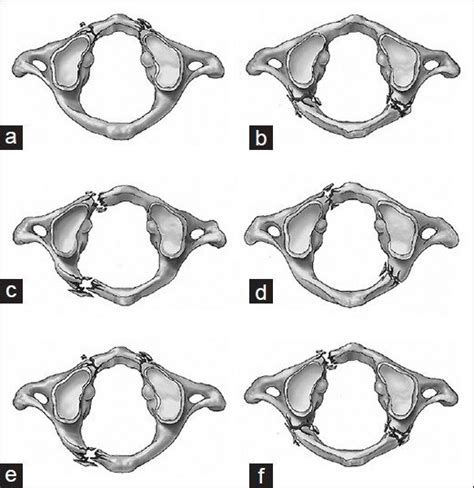 A Line Diagram Showing Anterior 12 Jefferson Fractures A And