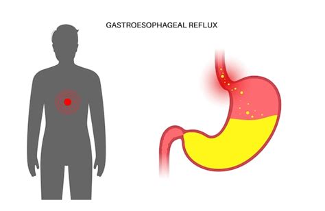 Gastro Oesofageale Refluxziekte Poster Spijsverteringsstoornis En Gerd