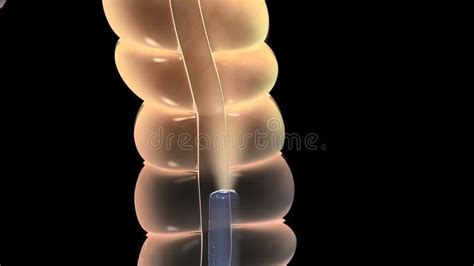 Colonoscopy Biopsy Of The Gastrointestinal Tract In Patients Stock