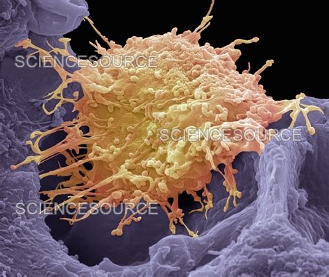 Cervical Cancer Cell SEM Stock Image Science Source Images