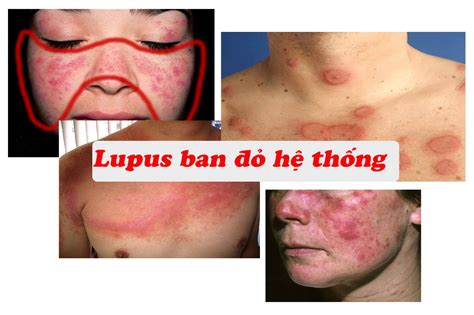 Lupus Ban Do La Benh Gi On Sale Emergencydentistry