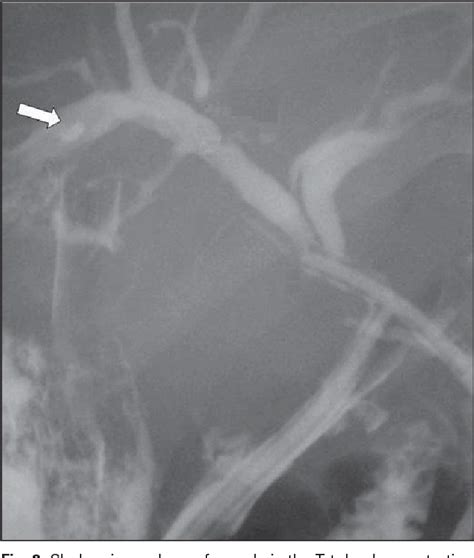 Figure 1 From Spontaneous Intrahepatic Echinococcal Cyst Rupture In A