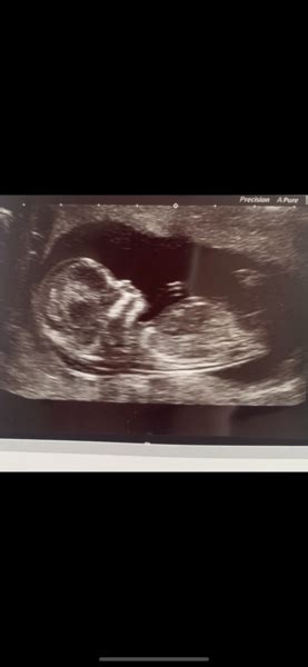 Guess The Gender From My Scan Picture Just For Fun Mumsnet