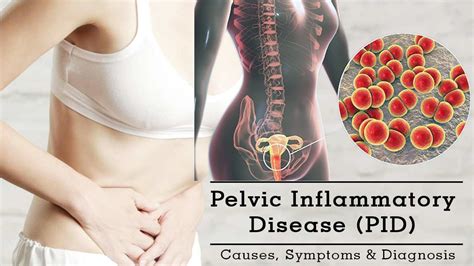 Pelvic Inflammatory Disease Pid Causes And Treatment Health Tips