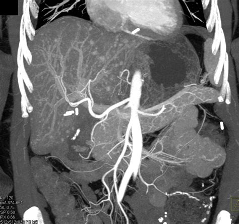 Carcinoid Tumor Metastatic To Liver Best Seen On Mip Images Liver