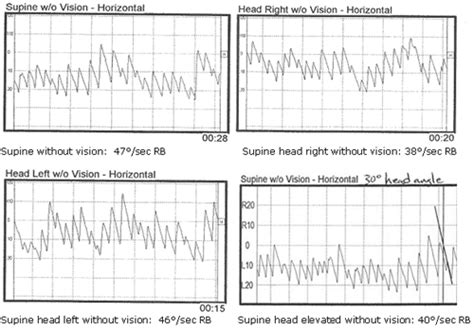 Vestibular Neuritis Acute Clinical Picture